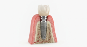 Implants dentaires en Côtes d'Armor - PISB